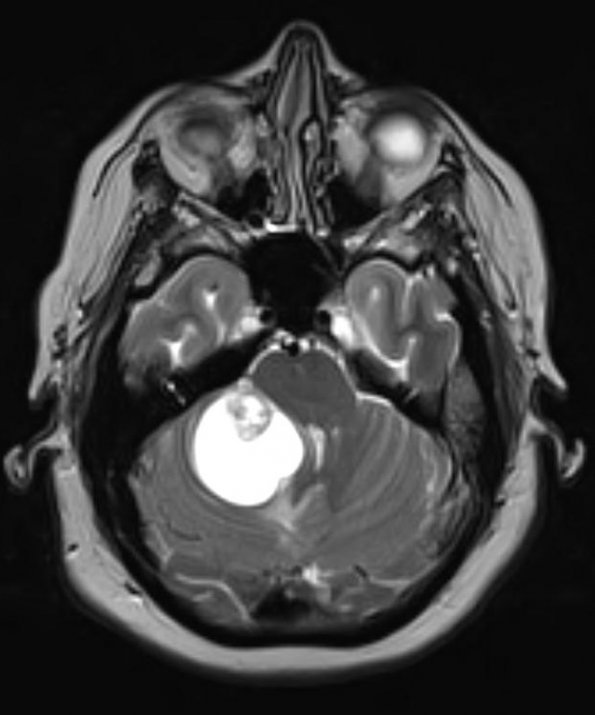 21A3 Hemangioblastoma (Case 21) T2 W 1 - Copy