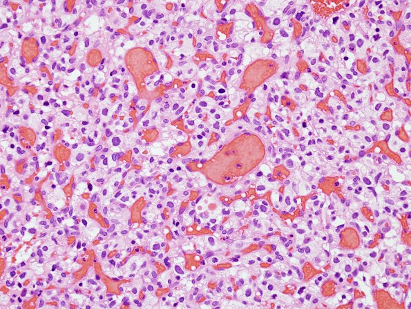 21B Hemangioblastoma (Case 21) H&E 3