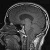 22A1 Hemangioblastoma (Case 22) T1 - Copy