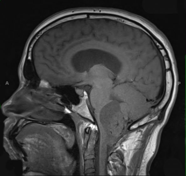 22A1 Hemangioblastoma (Case 22) T1 - Copy