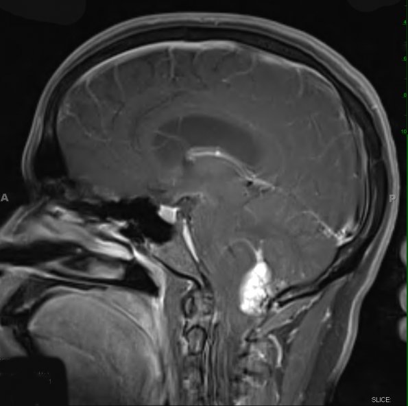 22A2 Hemangioblastoma (Case 22) T1 W 2 - Copy