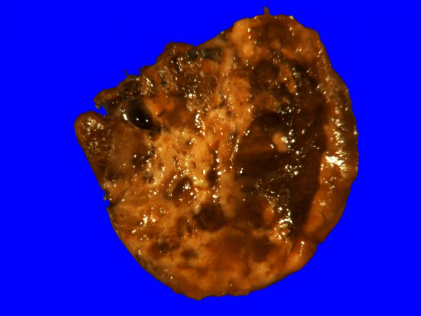 22B Hemangioblastoma (Case 22) Gross_3