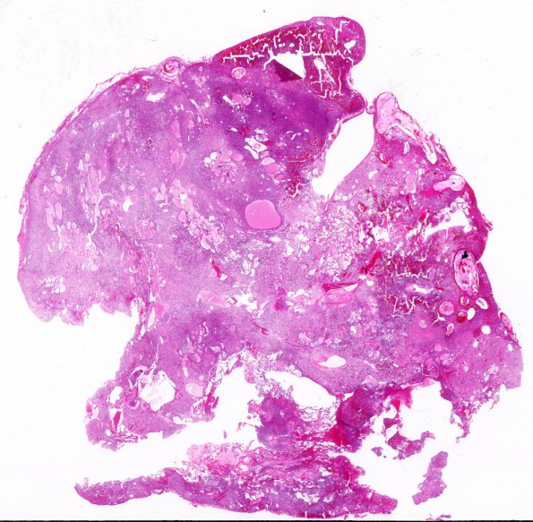 22C1 Hemangioblastoma (Case 22) H&E WM