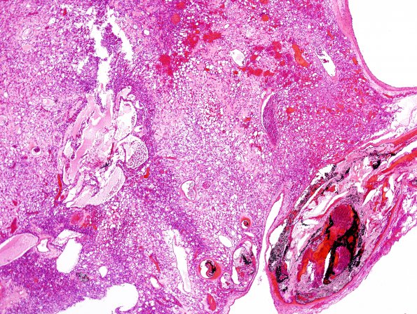 22C2 Hemangioblastoma (Case 22) H&E 7