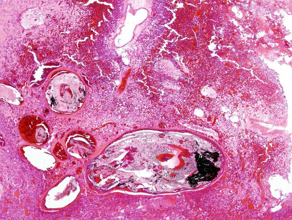 22C3 Hemangioblastoma (Case 22) H&E 6