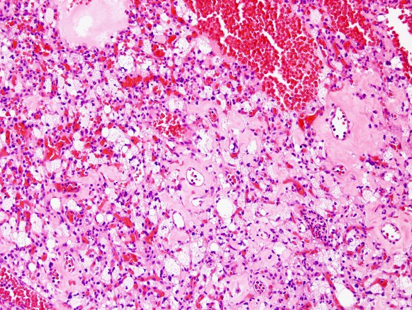 22C4 Hemangioblastoma (Case 22) H&E 4