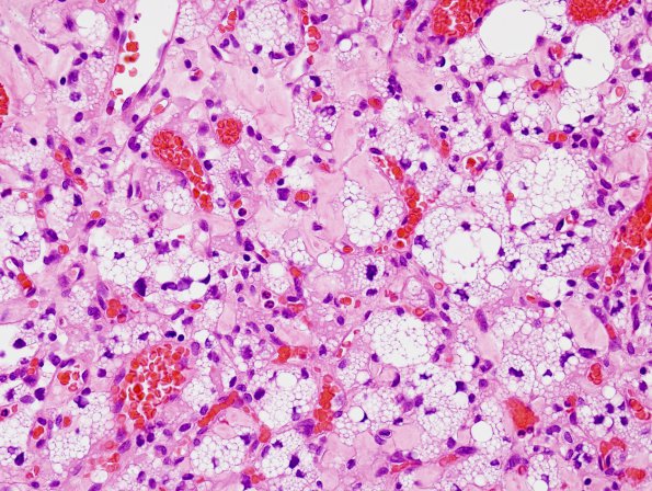 22C5 Hemangioblastoma (Case 22) H&E 5