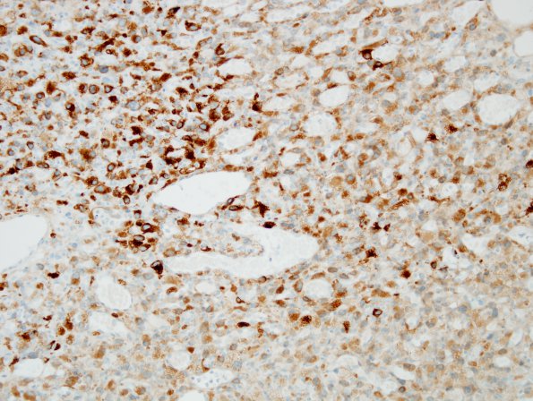 22E Hemangioblastoma (Case 22) Inhibin 2