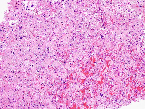 23A1 Hemangioblastoma (Case 23) H&E 2