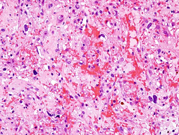 23A2 Hemangioblastoma (S10-24940) H&E 1