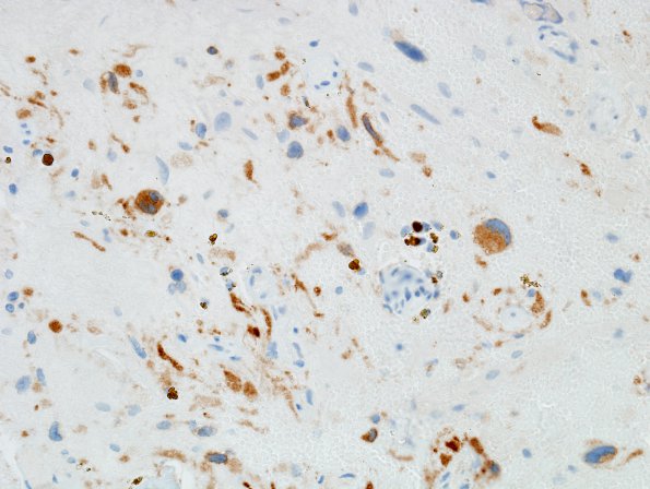 23C Hemangioblastoma (Case 23) Inhibin