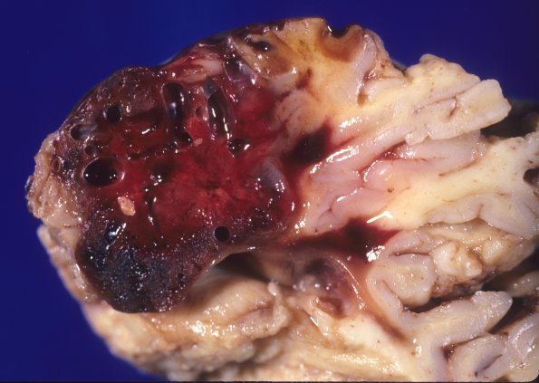 24A3 Hemangioblastoma (Case 24) 2