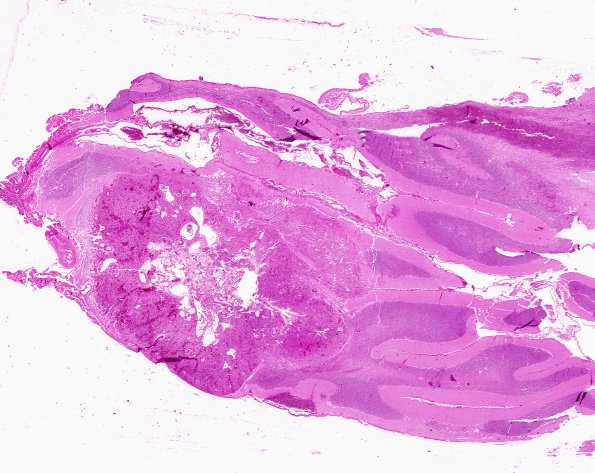 24A4 Hemangioblastoma (Case 24) H&E