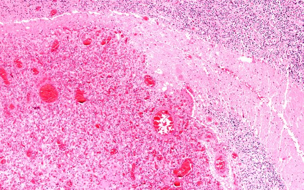 24A5 Hemangioblastoma (Case 24) H&E 10X