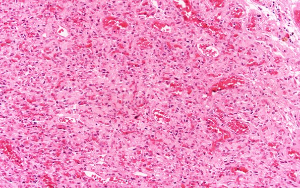 24A6 Hemangioblastoma (Case 24) H&E 20X