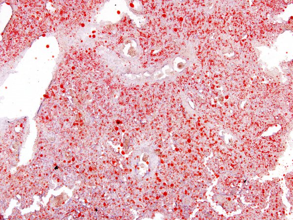 24A7 Hemangioblastoma (Case 24) ORO 1