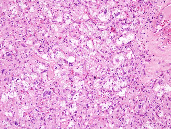 26 Hemangioblastoma (Case 26) H&E