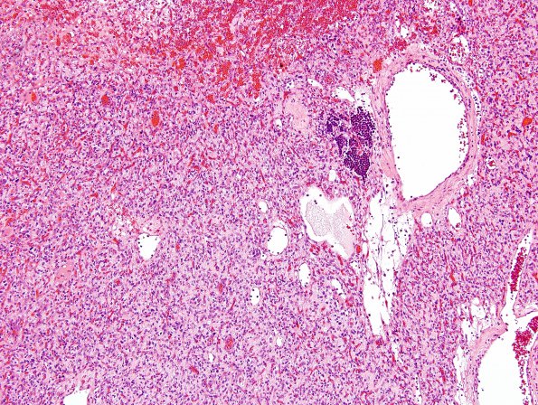 27A Hemangioblastoma & EMH (Case 27) H&E 3