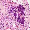 27B Hemangioblastoma & EMH (Case 27) H&E 1