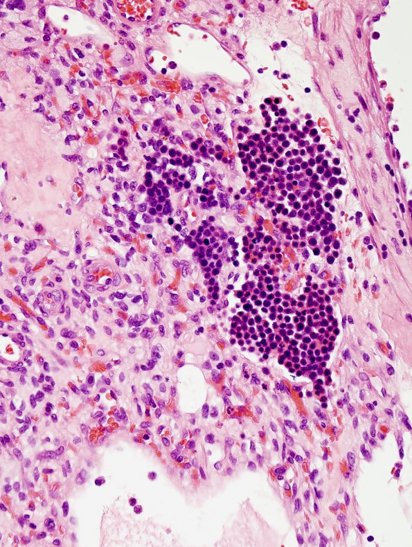 27B Hemangioblastoma & EMH (Case 27) H&E 1