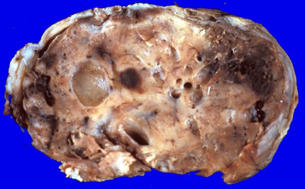 28 Hemangioblastoma (Case 28)