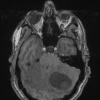 2A1 Hemangioblastoma (Case 2) T1 no contrast - Copy