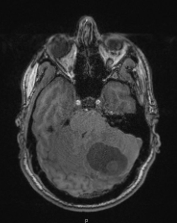 2A1 Hemangioblastoma (Case 2) T1 no contrast - Copy