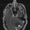 2A2 Hemangioblastoma (Case 2) T1 with contrast - Copy