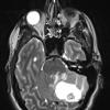 2A3 Hemangioblastoma (Case 2) T2 with contrast - Copy