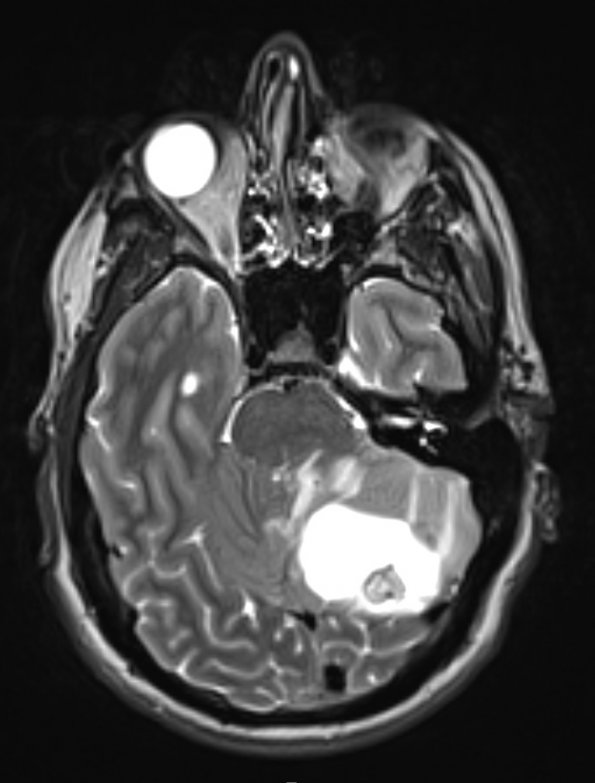 2A3 Hemangioblastoma (Case 2) T2 with contrast - Copy