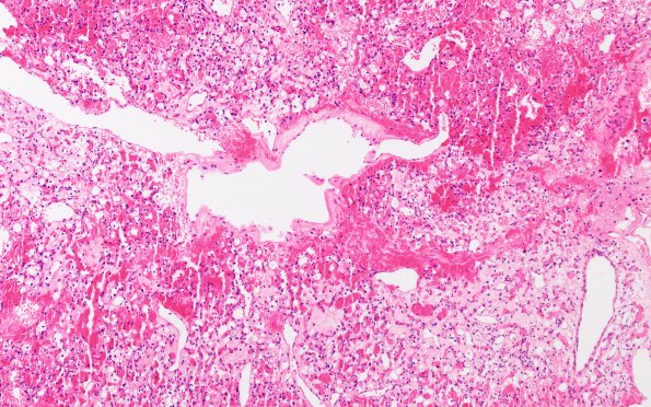 2B1 Hemangioblastoma (Case 2) H&E 2