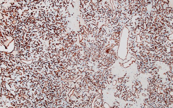 2C Hemangioblastoma (Case 2) CD31 2