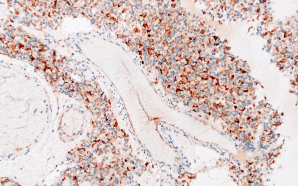 2D Hemangioblastoma (Case 2) Inhibin 3