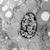 30 Hemangioblastoma (Case 30) EM - Copy