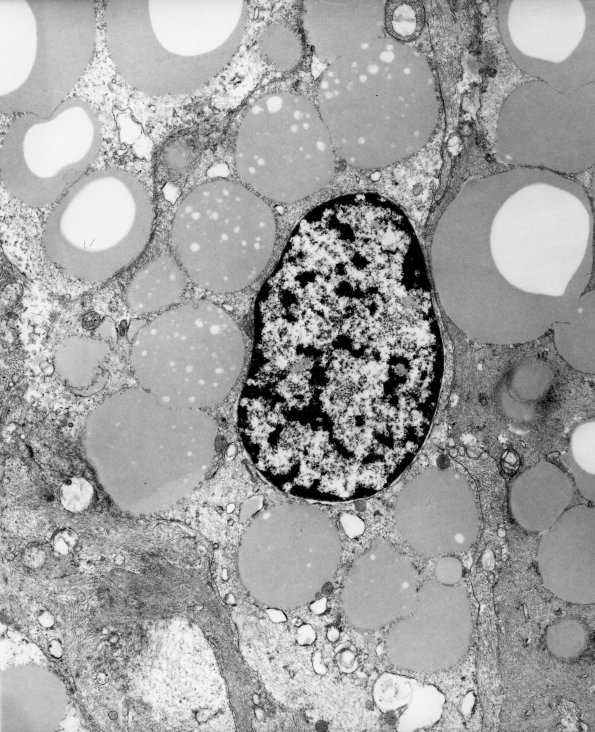 30 Hemangioblastoma (Case 30) EM - Copy