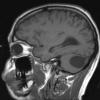 3A1 Hemangioblastoma (Case 3) T1 1 - Copy