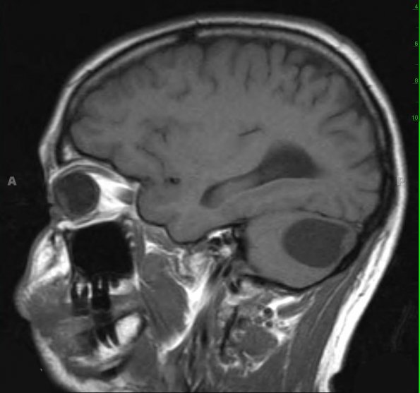 3A1 Hemangioblastoma (Case 3) T1 1 - Copy