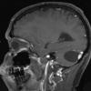 3A2 Hemangioblastoma (Case 3) T1 W 2 - Copy