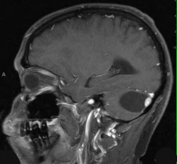 3A2 Hemangioblastoma (Case 3) T1 W 2 - Copy