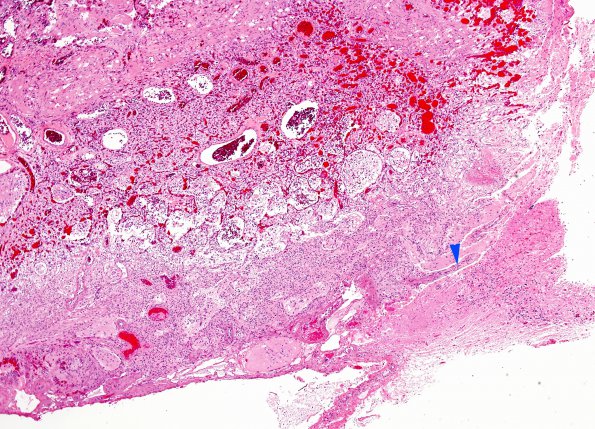 3B1 Hemangioblastoma (Case 3) H&E 2C copy