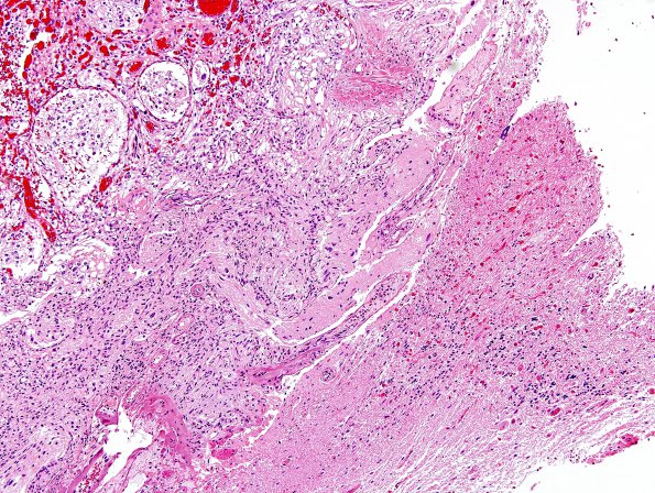 3B2 Hemangioblastoma (Case 3) H&E 2B