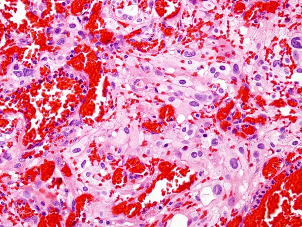 3B4 Hemangioblastoma (Case 3) H&E 1