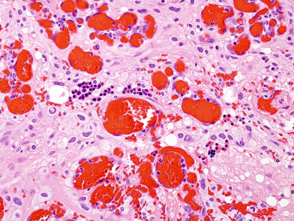 3B5 Hemangioblastoma (Case 3) H&E extramed hematopoiesis