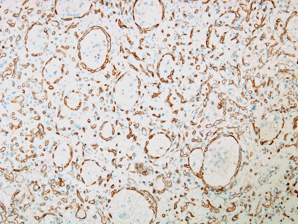 3C Hemangioblastoma (Case 3) CD34 1