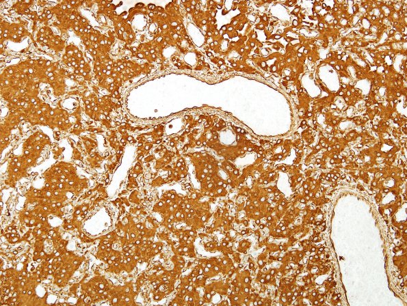 3F Hemangioblastoma (Case 3) VIM