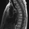 4A1 Hemangioblastoma (Case 4) T1 1 - Copy