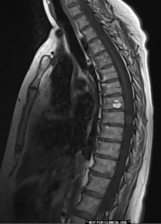 4A1 Hemangioblastoma (Case 4) T1 1 - Copy