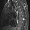 4A2 Hemangioblastoma (Case 4) T1 W1 - Copy