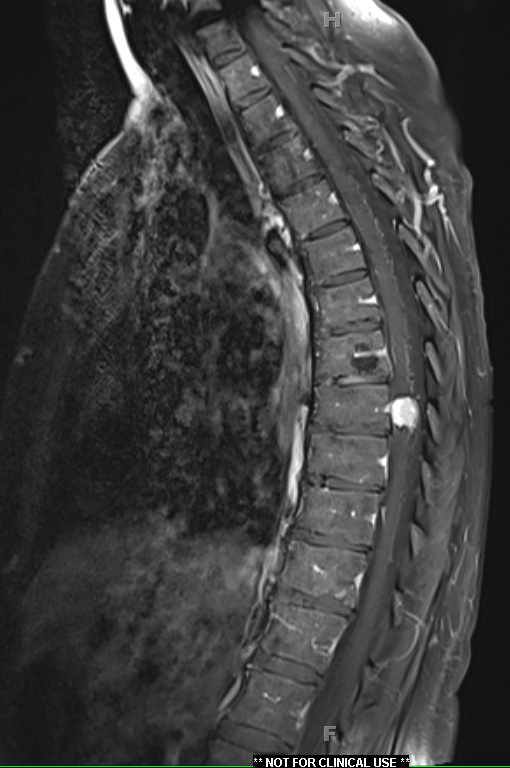 4A2 Hemangioblastoma (Case 4) T1 W1 - Copy