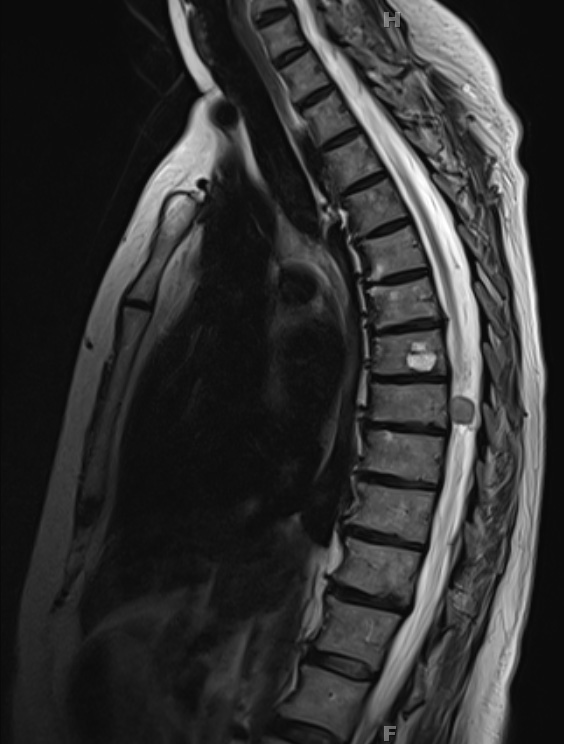 4A3 Hemangioblastoma (Case 4) T2 1 - Copy